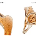 Osteoporosi cause e rimedi naturali osteoporosi