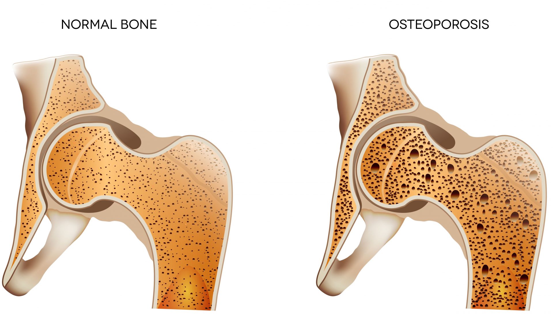 Osteoporosi Cause E Rimedi Naturali Naturopata Gaia Bassi