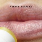 Herpes sinplex, cause e rimedi naturali herpes simplex - esistere bene
