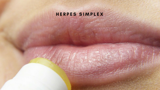 herpes simplex - esistere bene