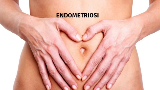 endometriosi-3 esistere bene