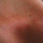 La pelle arrossata: quali sono i rimedi per curarla? pelle arrossata - rimedi naturali