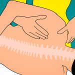 Sciatalgia: cause e rimedi dell’infiammazione del nervo sciatico nervo sciatico