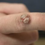 Verruche, cause e rimedi naturali Verruche cause e rimedi naturali