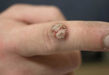 Verruche, cause e rimedi naturali Verruche cause e rimedi naturali