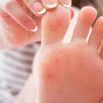 Verruche plantari: cause, sintomi e rimedi in farmacia verruche plantari