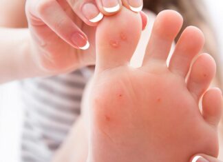 Verruche plantari: cause, sintomi e rimedi in farmacia verruche plantari